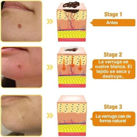 Tag Recede Eliminador de verrugas